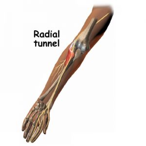 سندروم تونل رادیال3