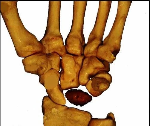 بیماری کین باخ یا نکروز استخوان لونیت