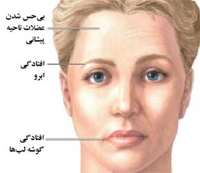 درمان فلج بلز –فلج یک طرفه غضلات صورت