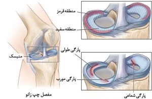 دانستنی هایی از منیسک