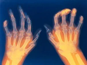 هر آنچه باید در بررسی بیماری آرتریت روماتوئید بدانیم! RA!