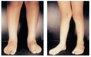پای ضربدری یا ژنووالگوم