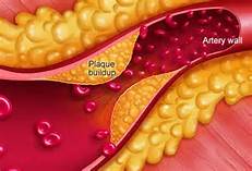 تشکیل پلاک در رگ های خونی