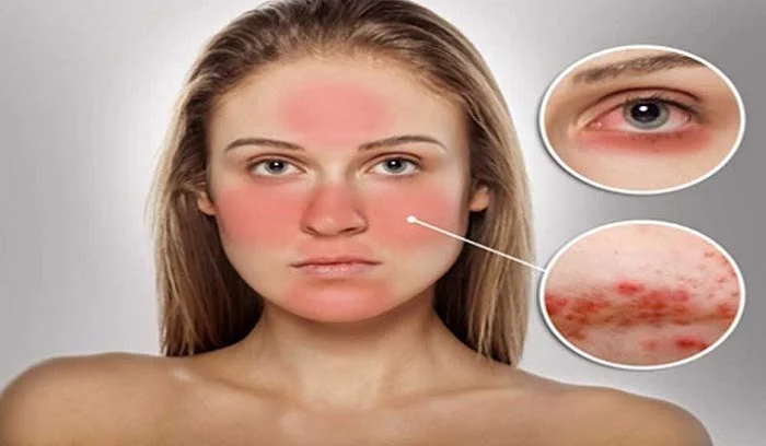 مهمترین نکات در باره لوپوس