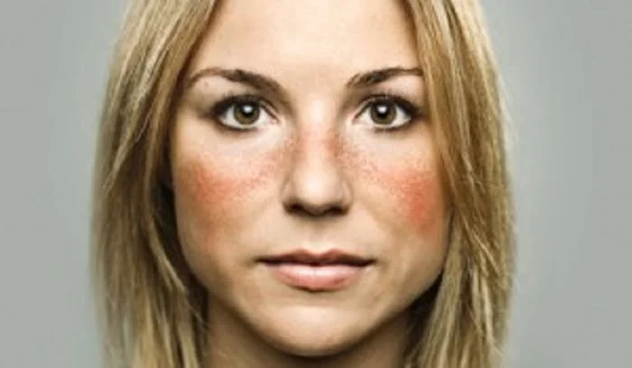 مهمترین تأثیر لوپوس بر مفاصل