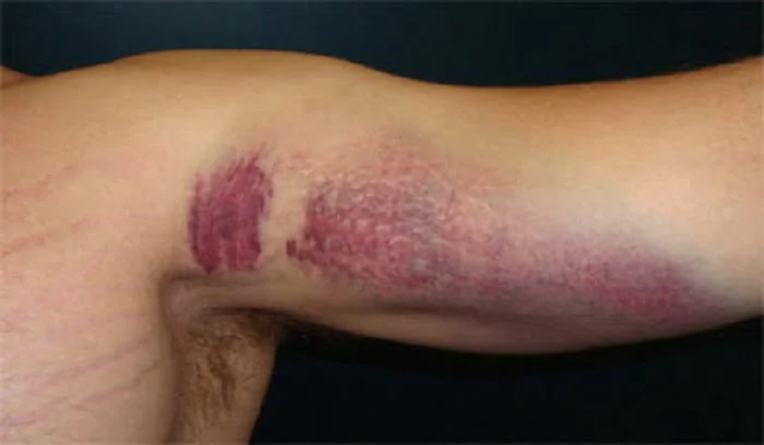 مؤثرترین درمان برای رابدومیولیز