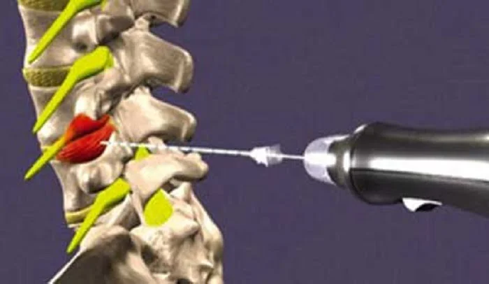 بهترین درمان سیاتیک