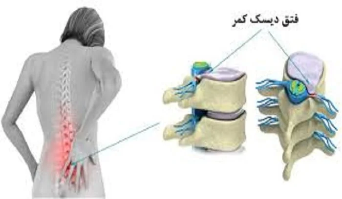 بهترین درمان برای فتق دیسک