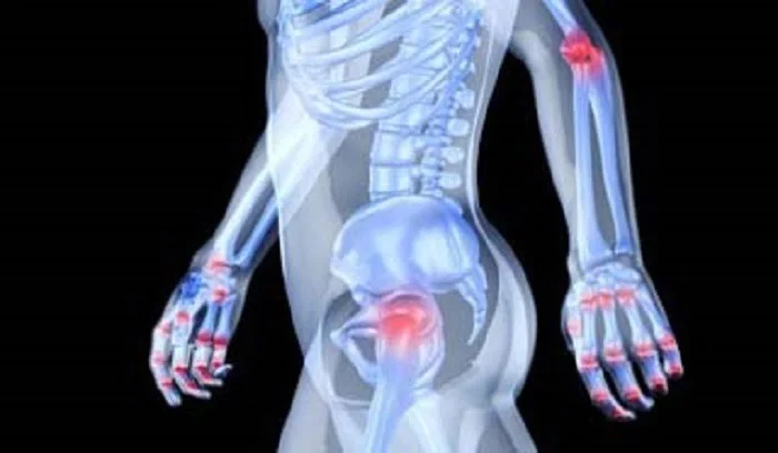 مؤثرترین روش های تشخیص آرتریت