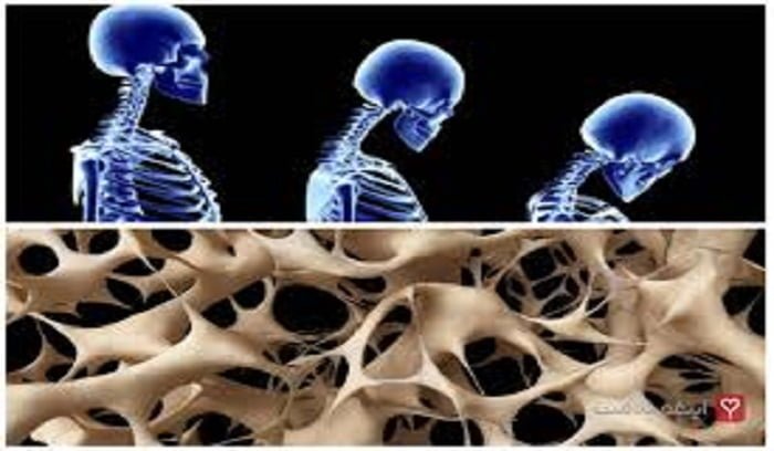 بهترین روش هایی برای محافظت از استخوان ها