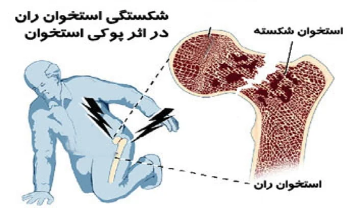 بهترین تغذیه برای استخوان های قوی