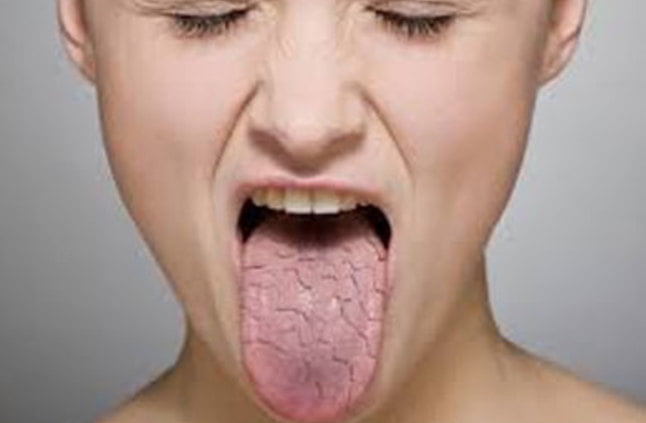خشکی دهان و دندان ها در افراد مبتلا به آرتروز 