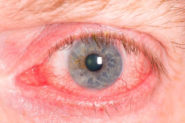 مشکلات چشم در افراد مبتلا به آرتروز