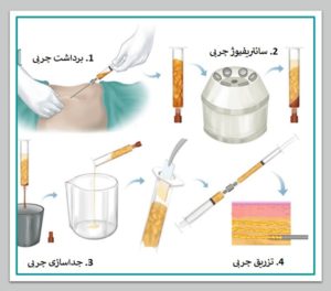بهترین جراح لیپوست در تهران