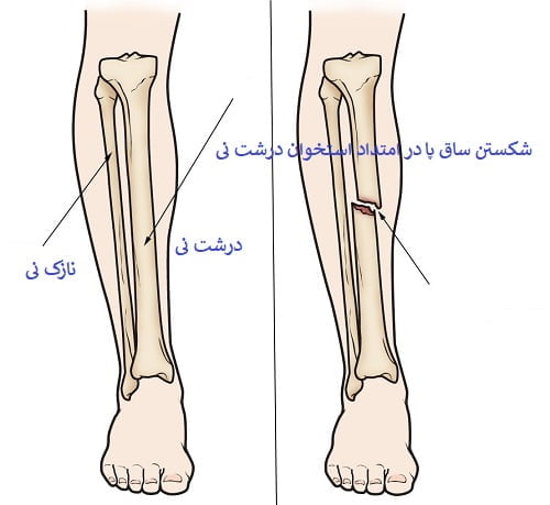 مراقبت بعد از شکستگی ساق پا