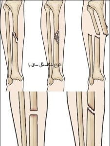 مراقبت بعد از شکستگی ساق پا: انواع ترک ساق پا
