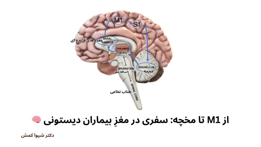دیستونی گردن دکتر شیوا کمش دکتر حمید نوراللهی مقدم